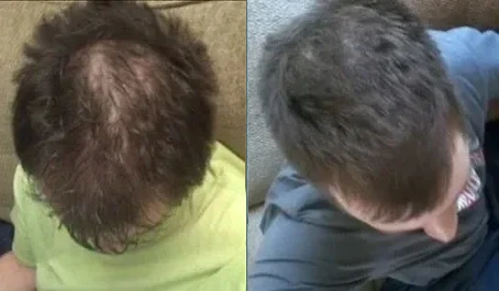 Before and after using RU-58841 as a Non-FDA Approved treatment for hair loss