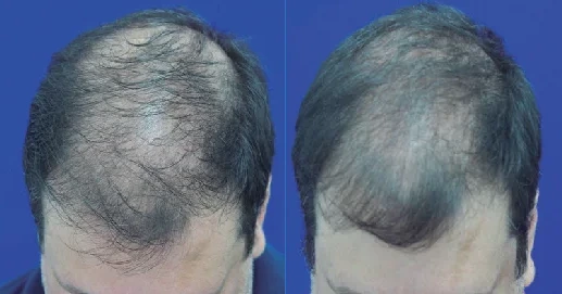 before and after using latanoprost to treat hair loss Non-FDA Approved