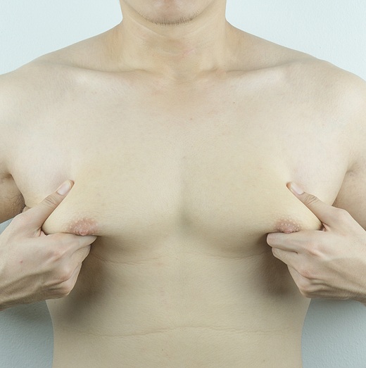 man shows of gyno (gynecomastia) from finasteride