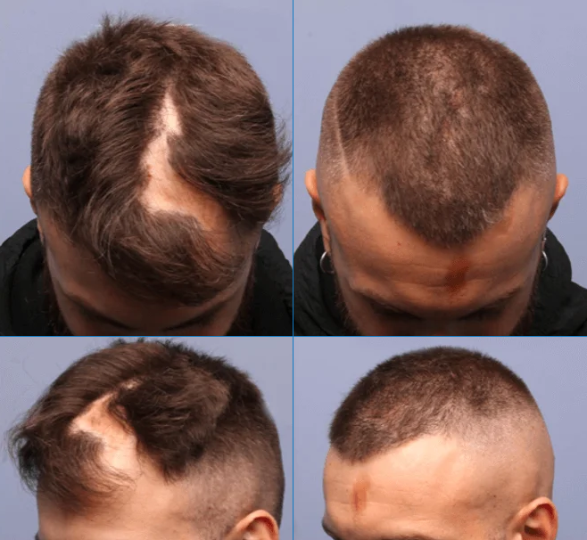 before and after a hair transplant to treat cicatricial alopecia (scarring alopecia)