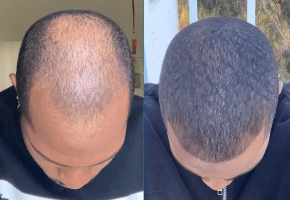 before and after showing the results of minoxidil (rogaine) to treat hair loss