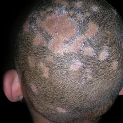 severe tinea capitis (ringworm of the scalp)