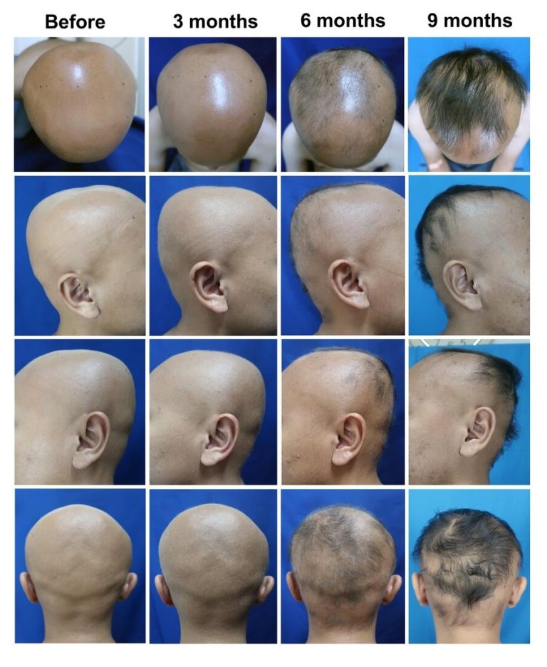 Showing the results of treating alopecia universalis at baseline, and 9 months