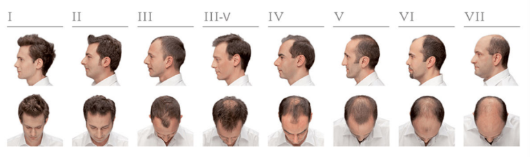 progression of hair loss