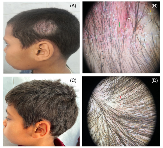 clinical study showing the before and after treating tinea capitis