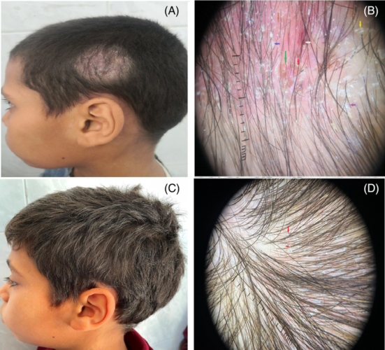 clinical study showing the before and after treating tinea capitis