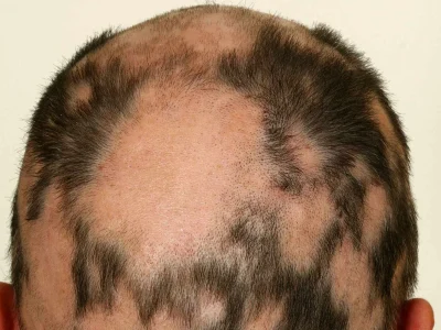 Close up of mans head showing alopecia areata hair loss