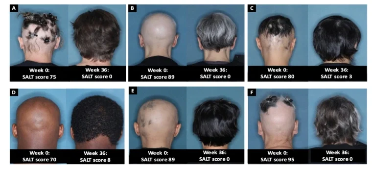 Close up of multiple people showing the results of using JAK inhibitors to treat alopecia areata