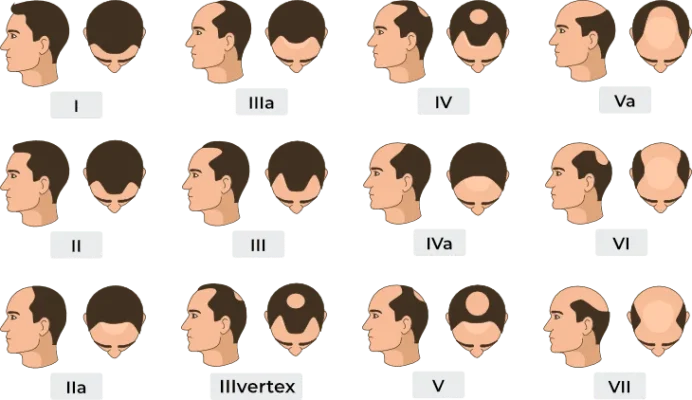 Norwood scale showing the progression of hair loss