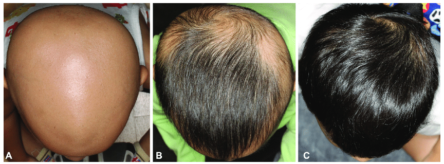 Patient with alopecia showing the before and after results with treatment