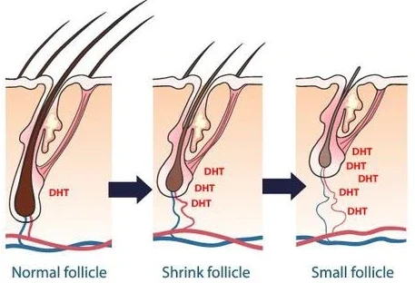 Showing-how-dht-impacts-the-hair-follicle-and-leads-to-hair-loss for androgenetic alopecia