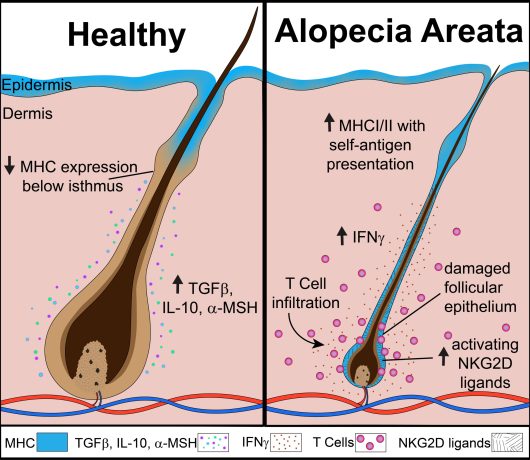 comparison of a healthy hair follicle and alopecia areata