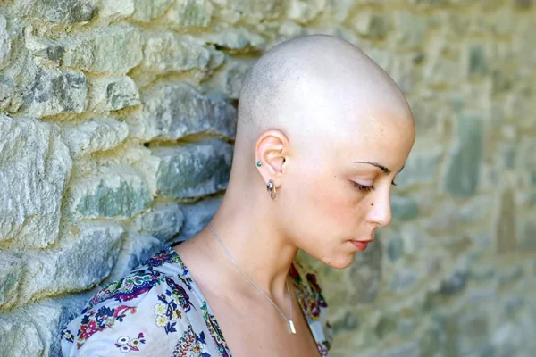 Profile of women showing showing alopecia totalis hair loss