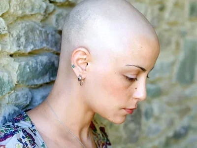 Profile of women showing showing alopecia totalis hair loss