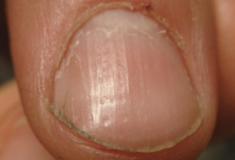 alopecia-totalis-fingernail-pitting