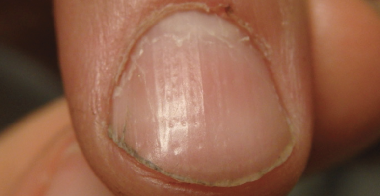 alopecia-totalis-fingernail-pitting