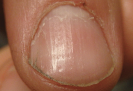 alopecia-totalis-fingernail-pitting