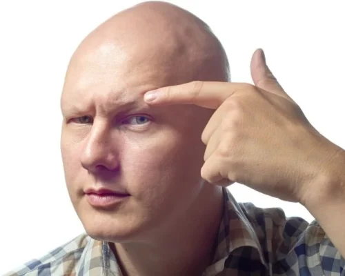 Man showing no eyebrows as a results of alopecia universalis hair loss
