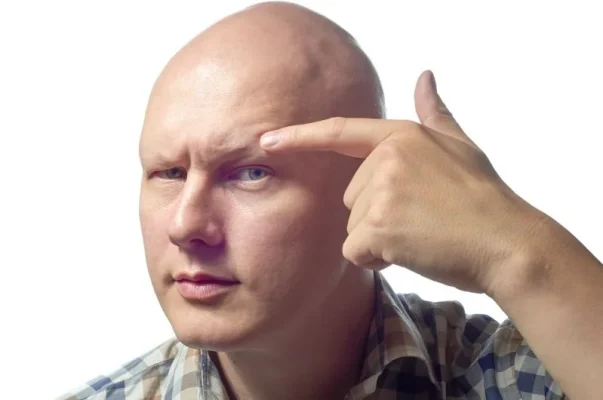 Man showing no eyebrows as a results of alopecia universalis hair loss