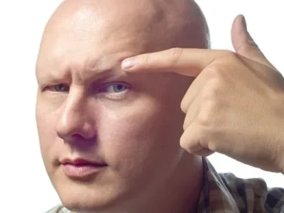 mans head showing alopecia universalis