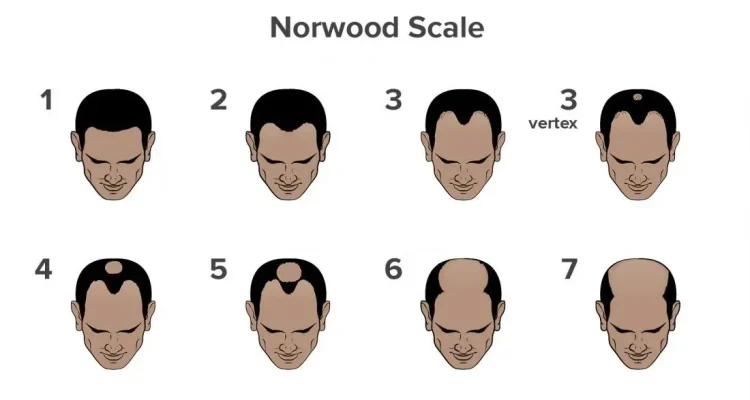 Norwood scale showing the 7 stages of hair loss