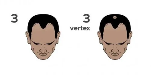 Stage 3 of the Norwood scale for hair loss