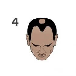 Stage 4 of the Norwood scale for hair loss