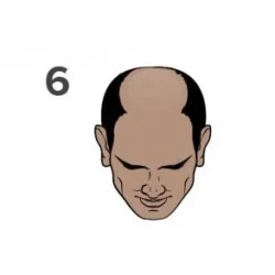 Stage 6 of the Norwood scale for hair loss