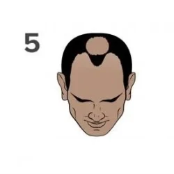 Stage 5 of the Norwood scale for hair loss