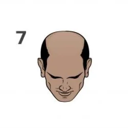 Stage 7 of the Norwood scale for hair loss