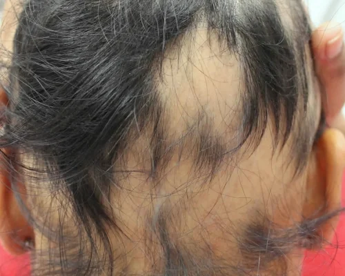 anagen-effluvium-ae Close up of scalp showing anagen effluvium hair loss