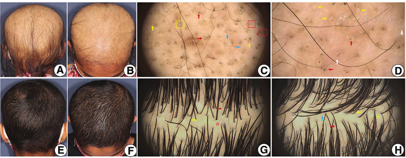 anagen-effluvium-treatment-results