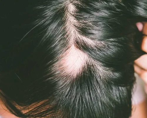 Cicatricial-Alopecia-ct Cicatricial Alopecia hair loss