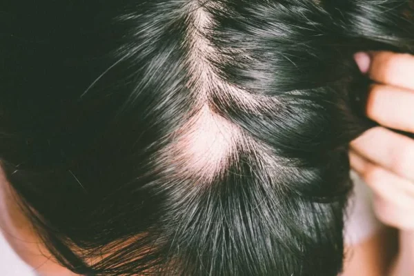 Cicatricial Alopecia hair loss