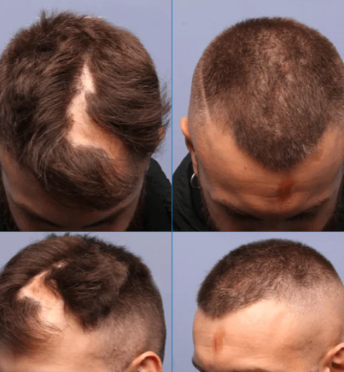 before and after a hair transplant to treat cicatricial alopecia (scarring alopecia)