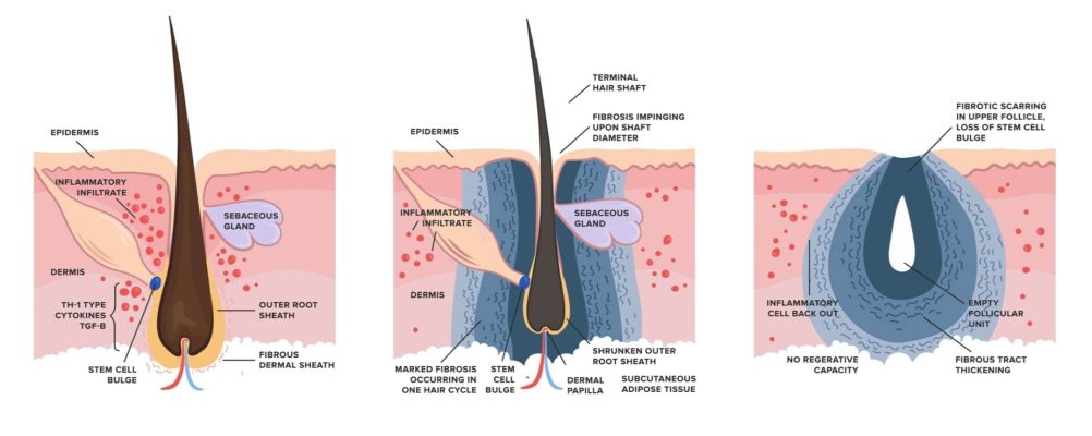 cicatricial alopecia (scarring alopecia) hair growth cycle