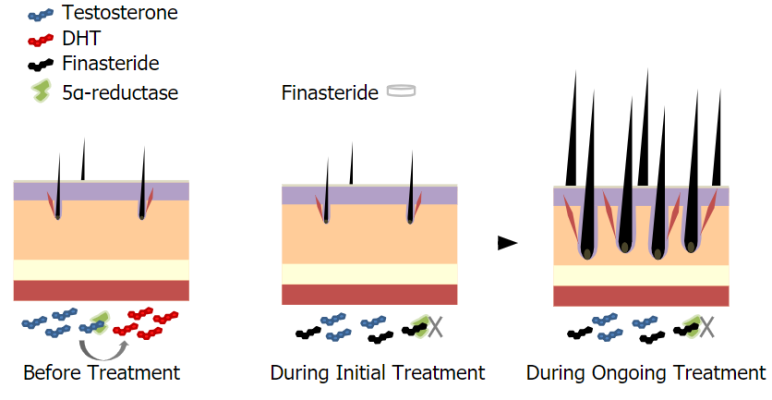 hair growth cycle showing finasteride blocking DHT production