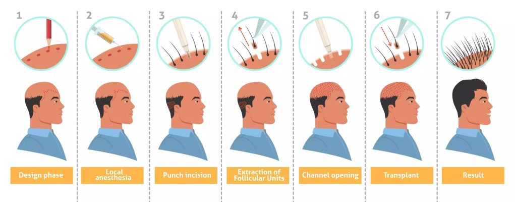 the procedure for a hair transplant