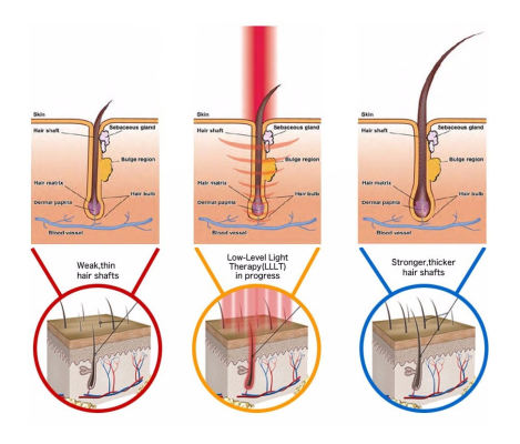 growth cycle of the hair follicle after being treated with low-level laser therapy (LLLT)