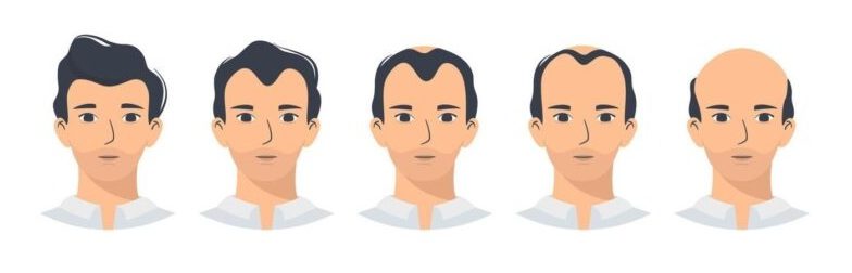 male-and-female-pattern-hair-loss-androgenetic-alopecia