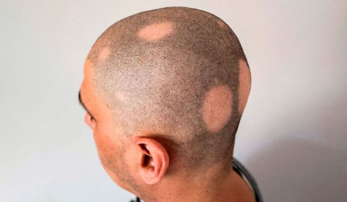 man with alopecia areata showing the patchy hair loss