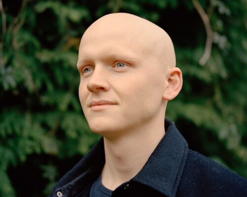 man with alopecia totalis showing no hair on his scalp