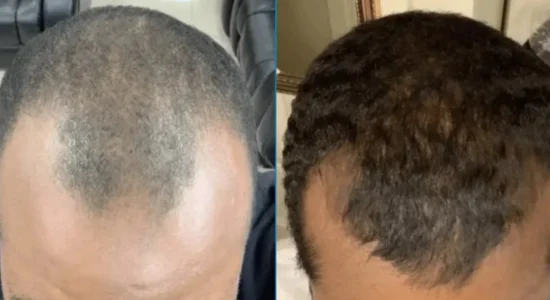 Close up showing before and after results of using minoxidil to treat hair loss and balding