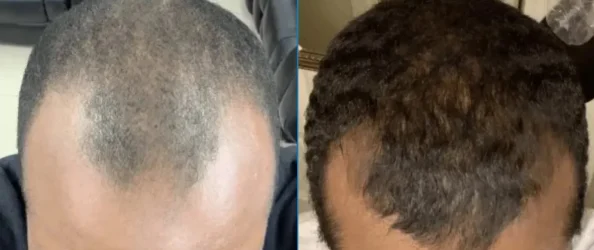 Close up showing before and after results of using minoxidil to treat hair loss and balding