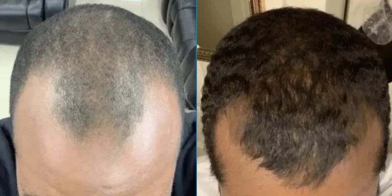 Close up showing before and after results of using minoxidil to treat hair loss and balding