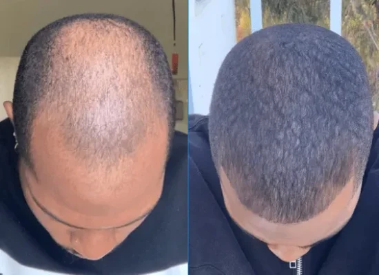before and after showing the results of minoxidil (rogaine) to treat hair loss