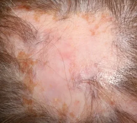 close up of cicatricial alopecia (scarring alopecia) showing smooth skin texture