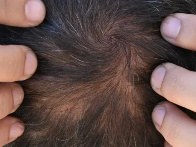 Close up of scalp showing telogen effluvium hair loss