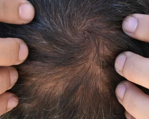 telogen-effluvium-te Close up of scalp showing telogen effluvium hair loss