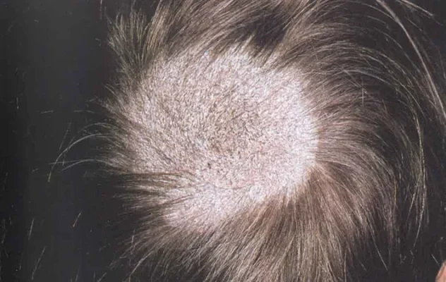 Close up of scalp showing tinea capitis hair loss